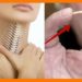Hóc xương cá xảy ra khi bạn không lọc xương hoặc ăn cá quá vội