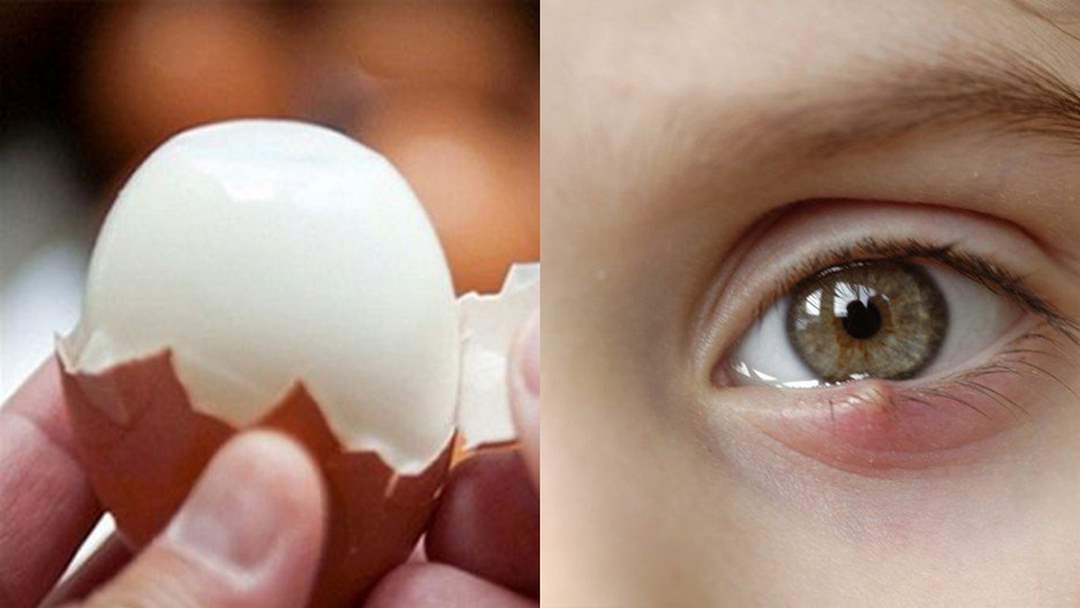 Cách chữa lẹo mắt từ trứng gà rất hiệu quả để nốt mụn xẹp