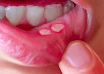 Bệnh nhiệt miệng Nhiệt miệng là một trong những bệnh lý thường gặp ở nhiều đối tượng