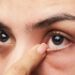 Lẹo mắt là bệnh lý có mụn lẹo xuất hiện ở mắt, gây đau, sưng, ngứa