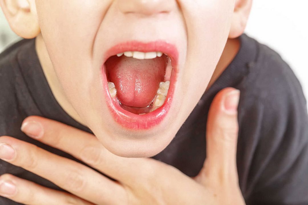 Vì sao nên phòng ngừa đau họng?