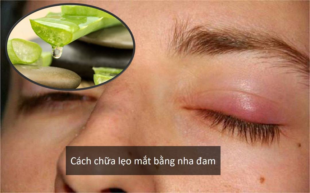 Hướng dẫn cách chữa lẹo mắt bằng nha đam hiệu quả