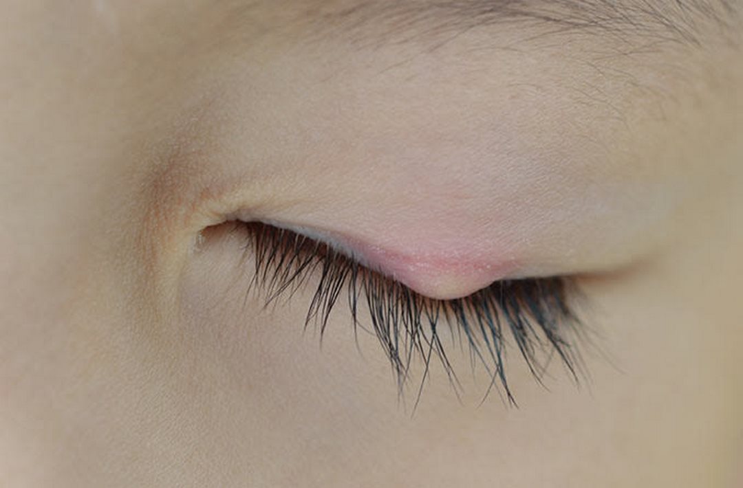Lẹo mắt là bệnh gì?