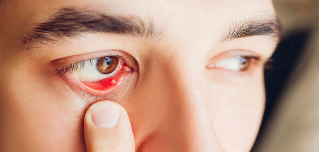 Lẹo mắt là căn bệnh phổ biến thường gặp