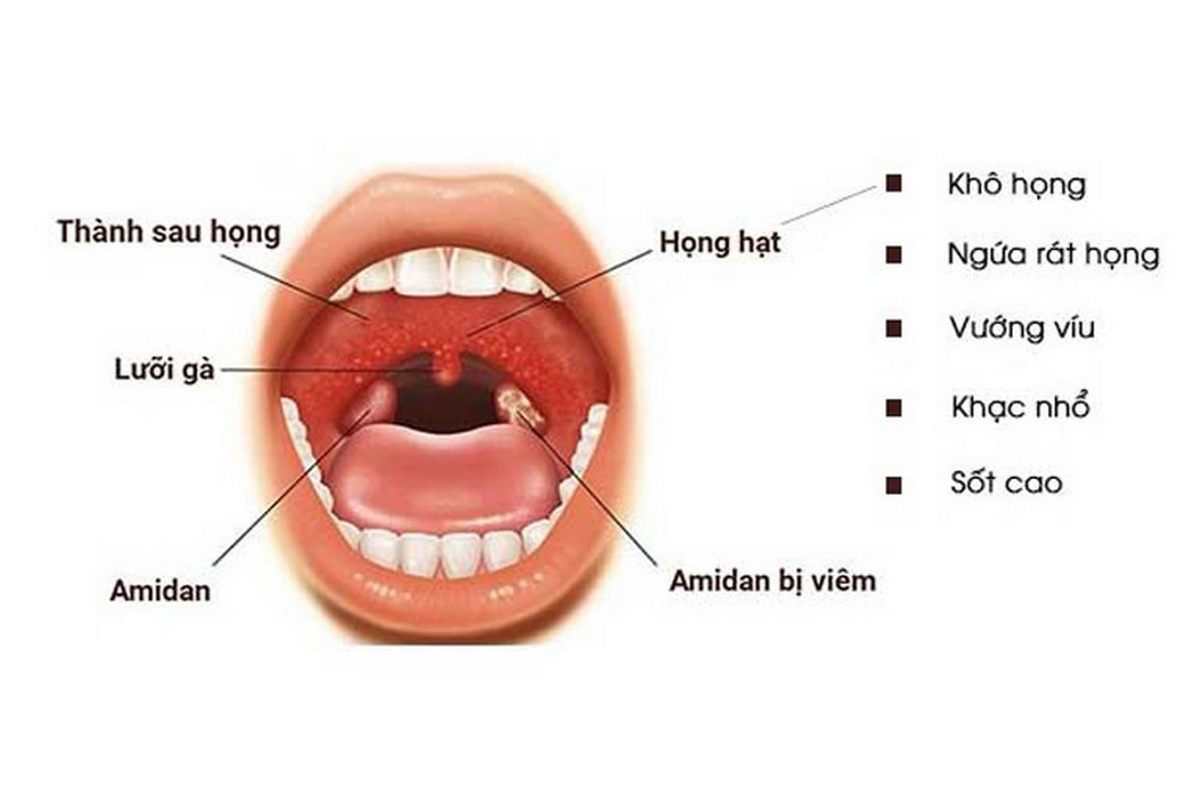 Các triệu chứng của đau họng