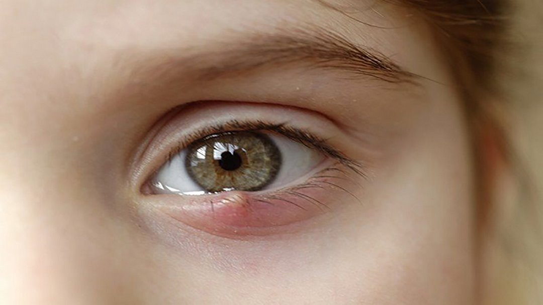 Những guyên nhân gây ra lẹo mắt phổ biến hiện nay