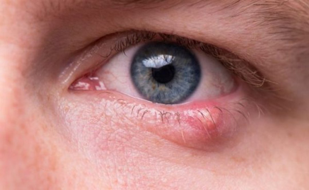 Các bước cần thiết để giảm nguy cơ lẹo mắt.