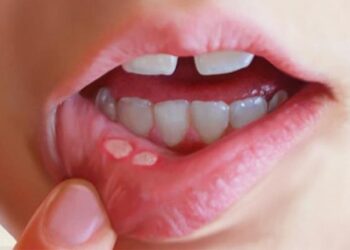 Cách trị nhiệt miệng trong 1 ngày - Mẹo hay dành cho bạn