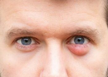 Các Loại Thuốc Được Sử Dụng Để Điều Trị Lẹo Mắt