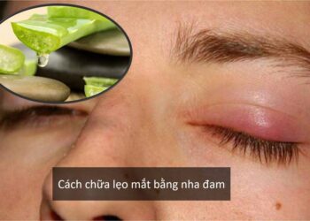 Hướng dẫn cách chữa lẹo mắt bằng nha đam hiệu quả