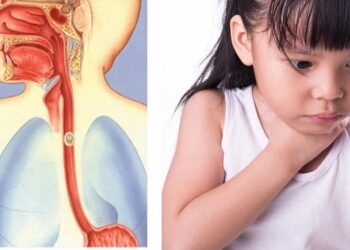 Những lưu ý khi bị hóc xương cá bạn cần biết để tránh nguy hiểm