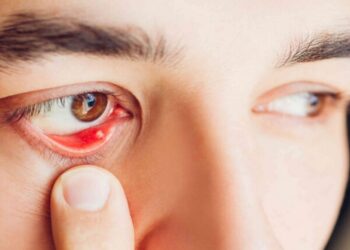 Lẹo mắt là căn bệnh phổ biến thường gặp