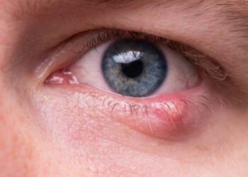 Các bước cần thiết để giảm nguy cơ lẹo mắt.