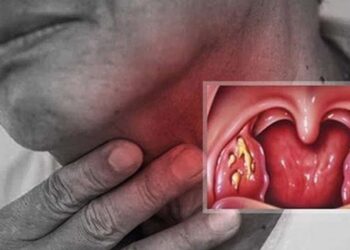 Triệu chứng của Đau Họng